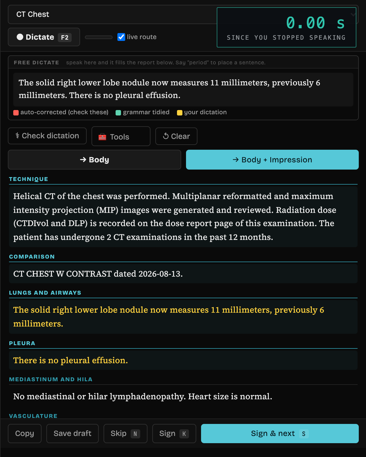 Animated, measured in the running product. A stopwatch sits above the dictation panel. First beat: two sentences already placed, the clock at zero. Second beat: 5.9 milliseconds, and the newly spoken sentence has been corrected, placed in Mediastinum and hila, and highlighted as newly written. Third beat: 18.1 milliseconds, and the impression has been composed from the findings.