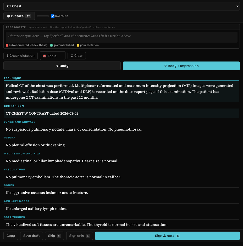 Animated: a reporting panel filling as five sentences are dictated one after another, each landing in its own section — nodule measurement into Lungs, no effusion into Pleura, adenopathy into Mediastinum, aorta into Vasculature, degenerative change into Bones.