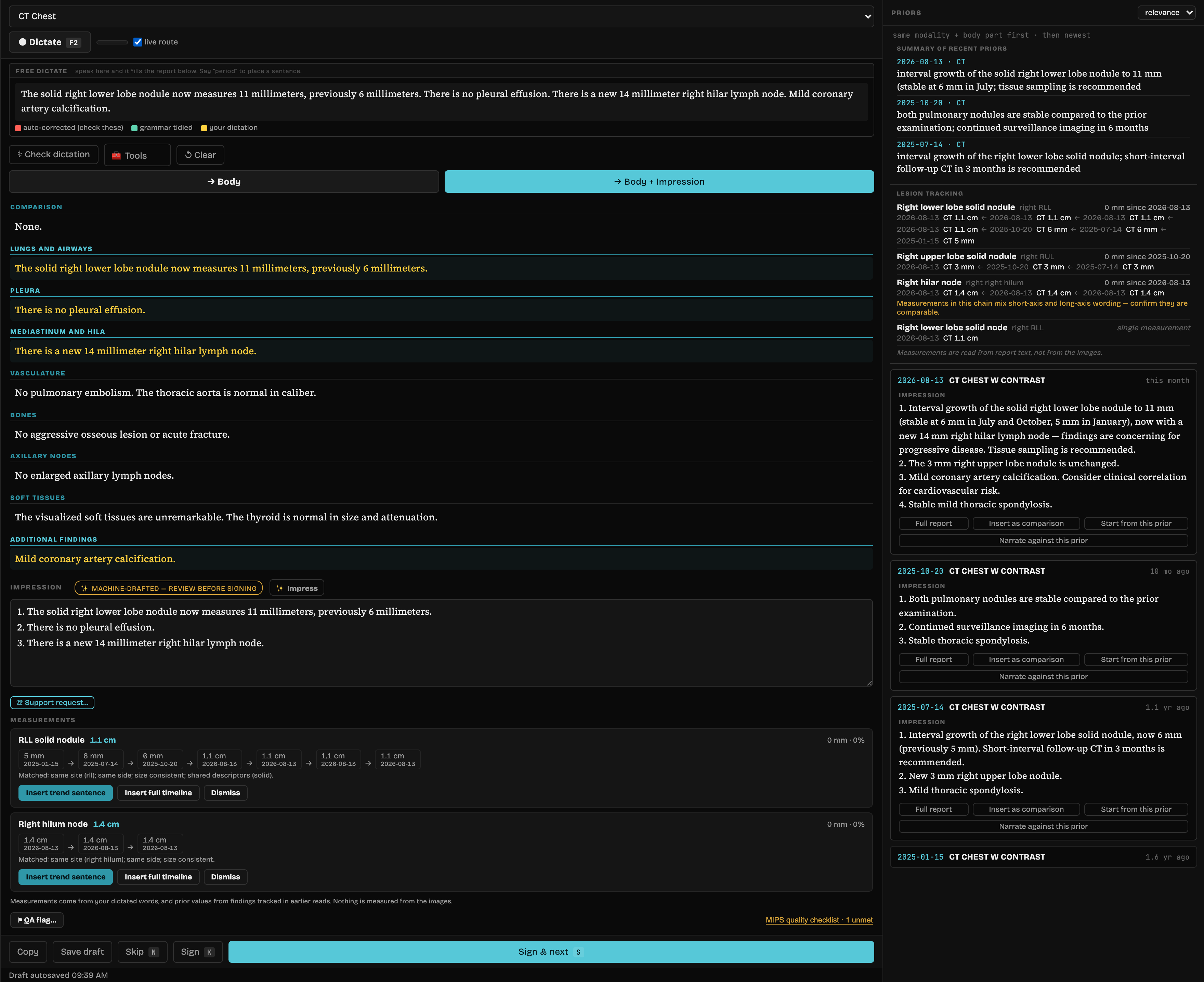 The full dictation screen in free-form mode: dictated sentences colour-coded and routed live into their sections, a composed impression, the measurement chain showing 5 mm to 11 mm, and a priors rail carrying the summary of recent priors, lesion tracking and three dated prior impressions.